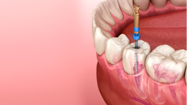 Tratamento de canal: quando ele é necessário e como ajuda a salvar seu dente