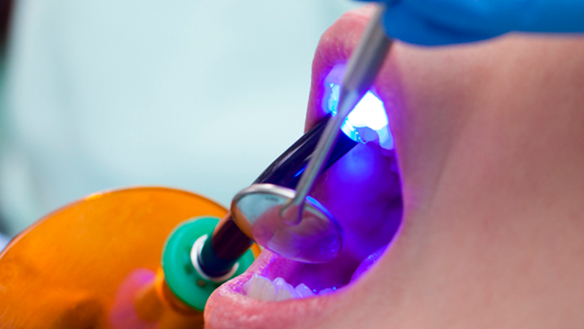 Cáries e restaurações: entenda o procedimento que protege seus dentes